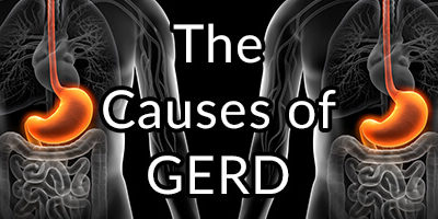 GERD (Heartburn), Causes, Treatment Issues, Supplements, and Relief