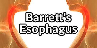 Barrett’s Esophagus, What Is It and What Can Be Done to Hopefully Reverse It