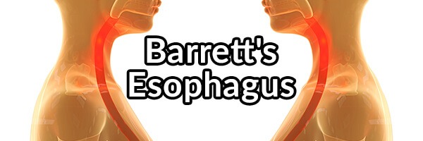 barretts-esophagus-what-it-is-and-what-to-do-to-hopefully-reverse-it-1